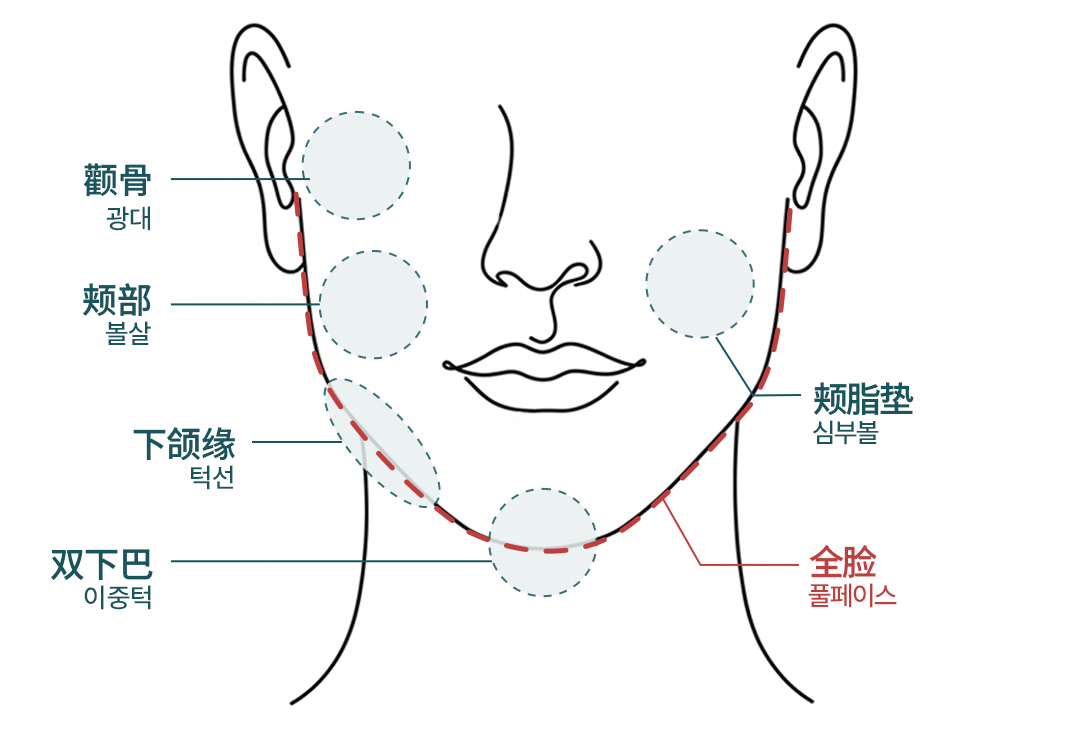 WonderFit 溶脂针脸部施作部位说明