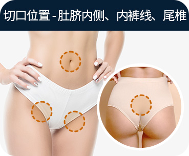 바디 지방흡입 절개부위 배꼽안쪽 팬티라인 꼬리뼈