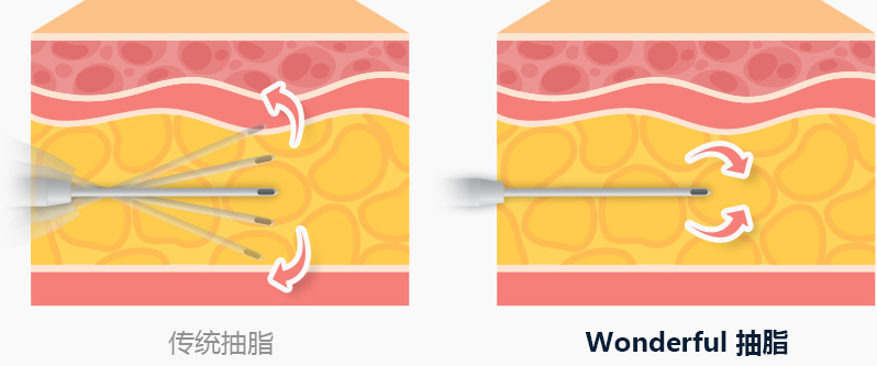 바디 지방흡입 주변조직 손상 최소화 전용캐뉼라 삽입