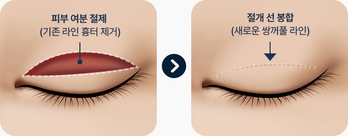 피부 연부조직 절제 피부 여유가 있는 경우