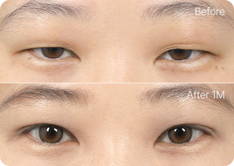 원더풀 완전절개 완전절개 눈꺼풀 지방제거 눈매교정 앞트임