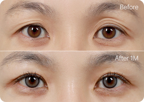 원더풀 완전절개 완전절개+눈위지방이식