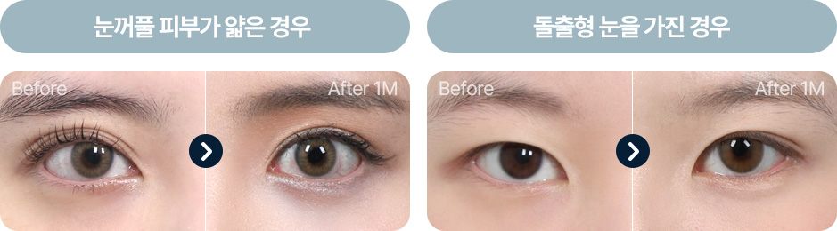 원더풀 자연유착 눈꺼풀이 얇은 경우 돌출형 눈을 가진 경우