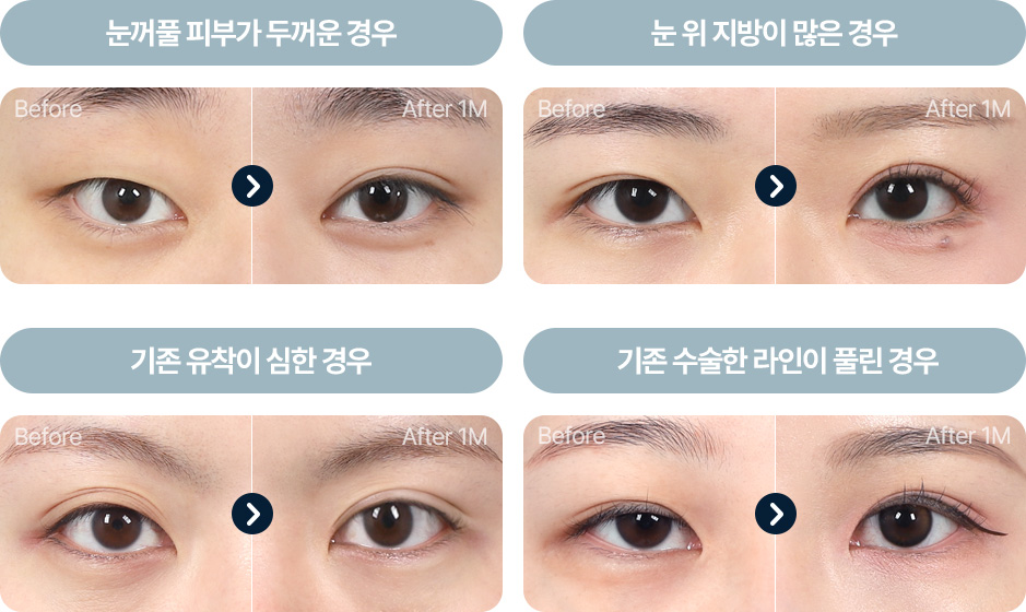 원더풀 부분절개 피부 근육이 두꺼운 경우 피부 처짐 눈위 지방이 많은경우 기존 유착이 심한경우 기존 라인을 낮추는 경우