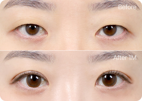 원더풀 부분절개 앞트임 눈매교정