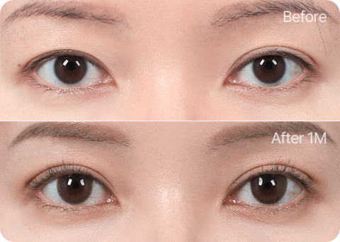 원더풀 부분절개 눈재수술