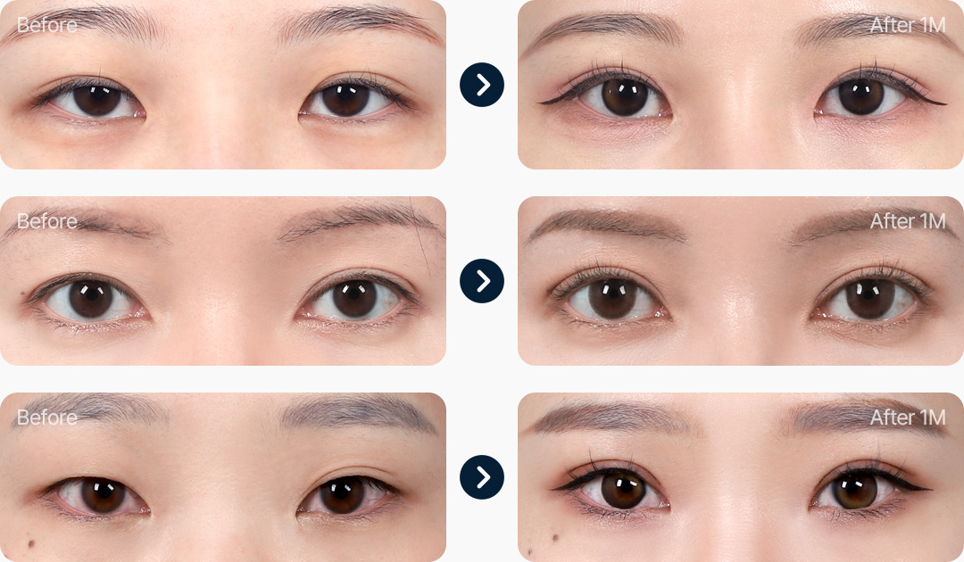 부분절개 전후사진