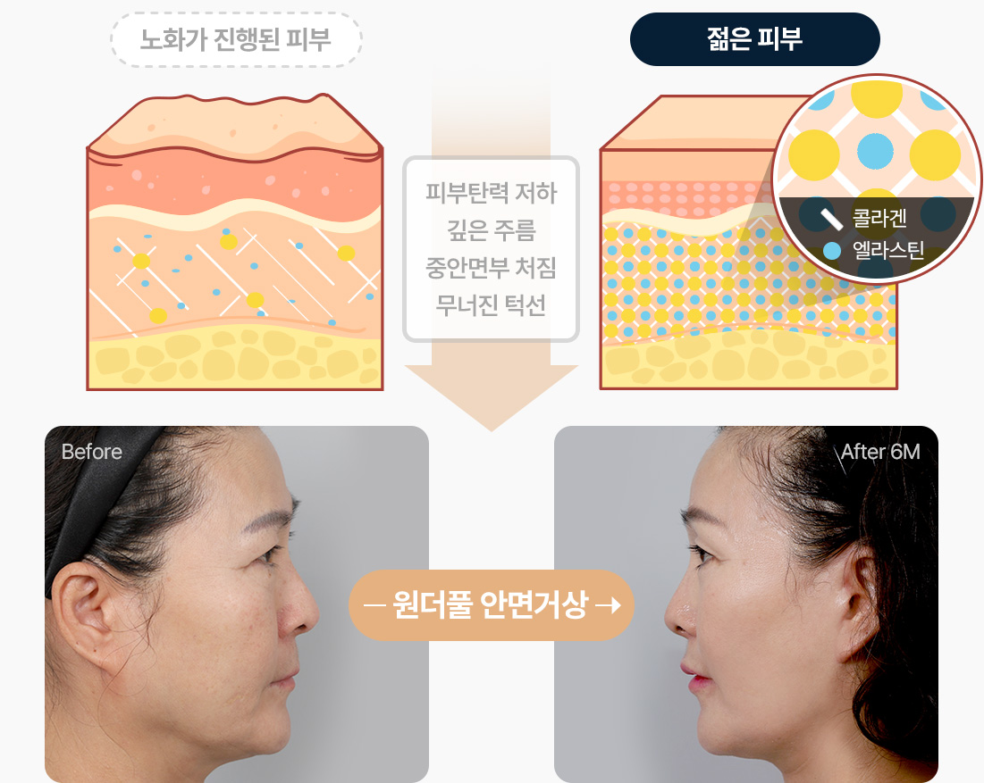 안면거상 노화 진행된 피부 피부탄력저하 깊은주름 중안면부처짐 무너진턱선 원더풀 안면거상 전후사진 안면거상 수술후기