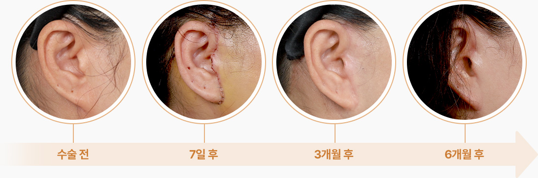 안면거상 섬세한 봉합 흉터 최소화 수술전 7일후 3개월후 6개월후 흉터최소
