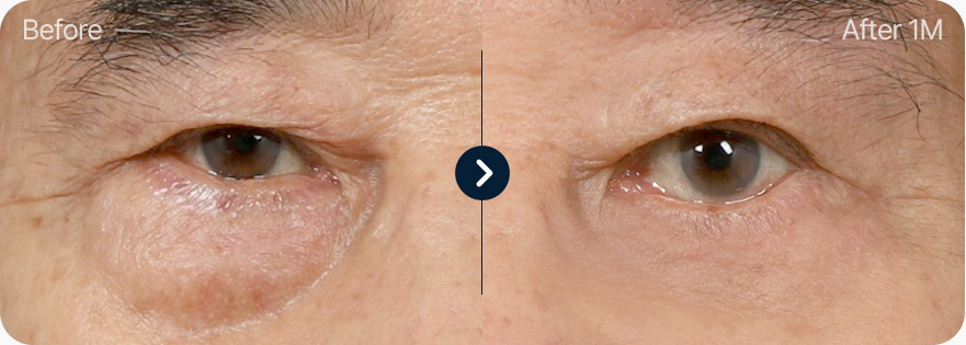 하안검 전후사진 하안검 수술후기