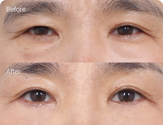 하안검 전후사진 하안검 후기