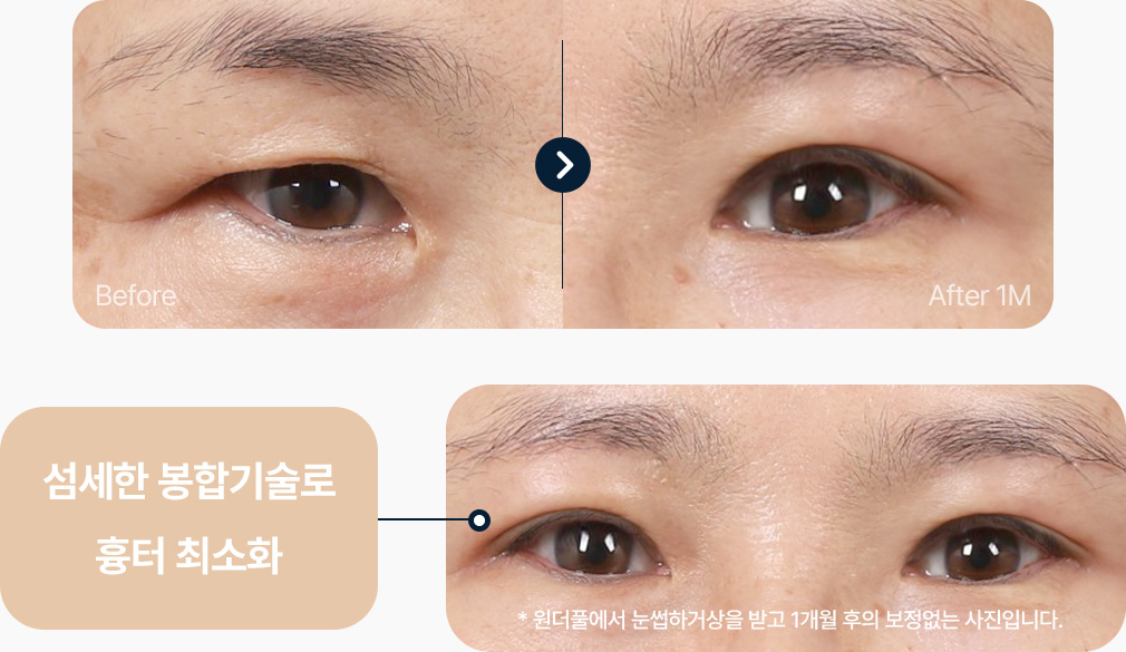 눈썹하거상술 전후사진 눈썹하거상술후기 섬세한 봉합기술 흉터최소화