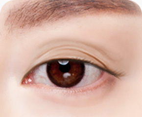 상안검 수술방법 눈꺼풀 처짐 피부상태 정밀진단 개인 맞춤 디자인계획