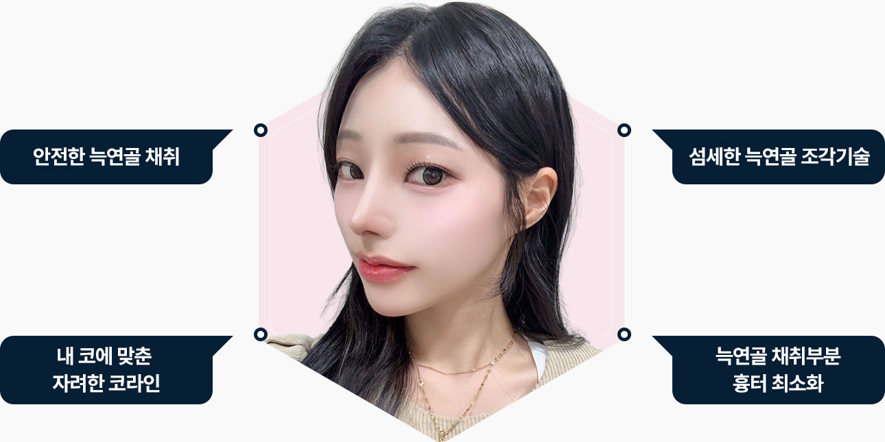 自体肋软骨隆鼻 #最佳安全性 #低吸收率＆坚固性