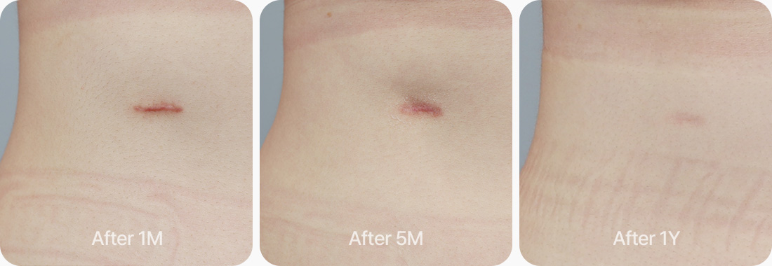 最小化肋软骨采集疤痕