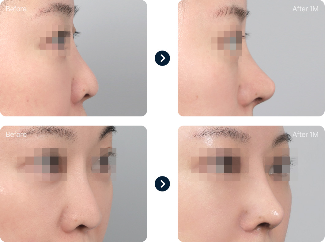 낮은코 성형 전후사진