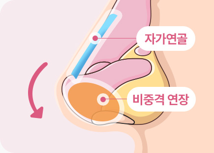 짧은코 들창코 수술 자가연골 비중격 연장
