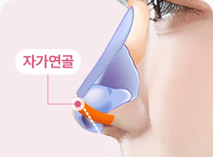 화살코 긴코 수술방법 자가연골