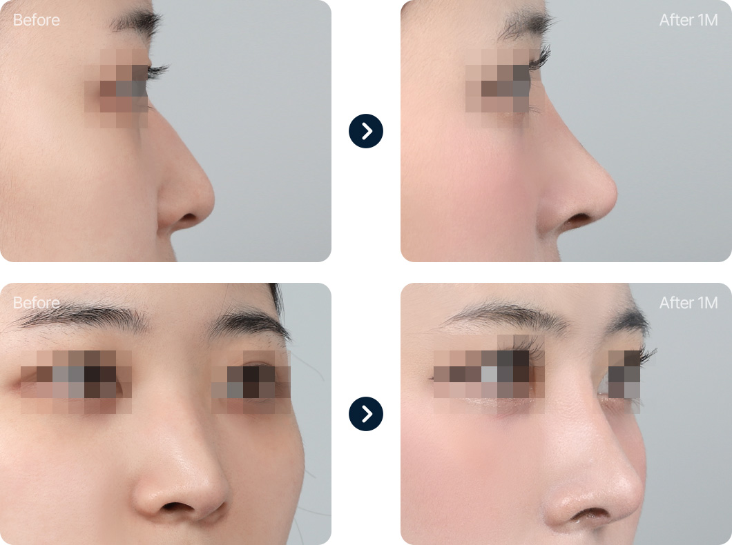 화살코 긴코 성형 전후사진