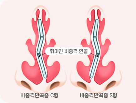 휘어진 비중격 연골 비중격 만곡증 C형 S형