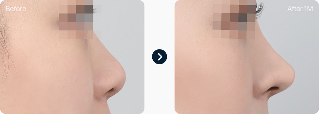 짧은코 코성형 전후사진