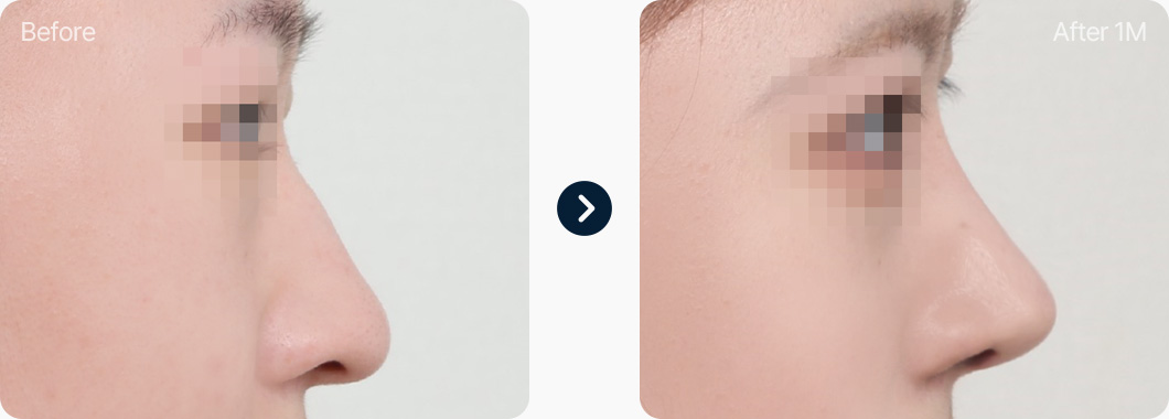 화살코 코성형 전후사진