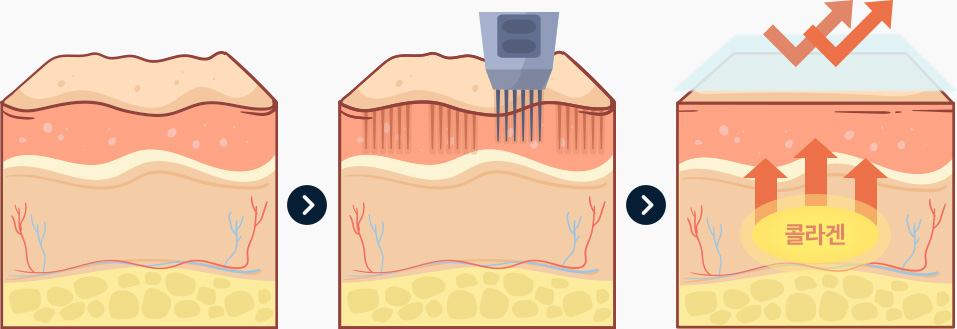 원더풀 밀키실크 패키지 올인원 케어 솔루션 콜라겐 재생
